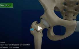 Subtrochanteric Hip fracture
