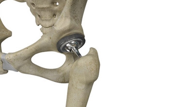 How Smart Technology Can Track Mobility and Have a Positive Impact in Joint Replacement