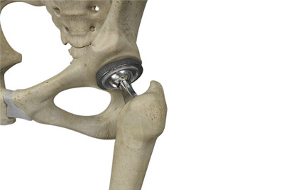 How Smart Technology Can Track Mobility and Have a Positive Impact in Joint Replacement