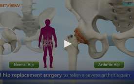 Revision Hip Replacement