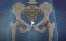 Total Hip Replacement