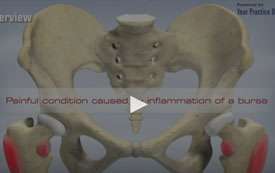 Hip Bursitis