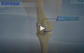 Total Knee Replacement